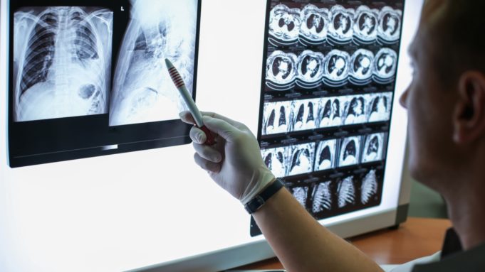 New Cases of Deadly Lung Cancer Are on the Rise Lung Cancer